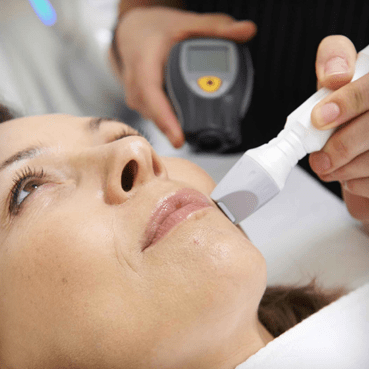 Radiofrequência fracionada FRAXX para cicatrizes de acne e rejuvenescimento facial